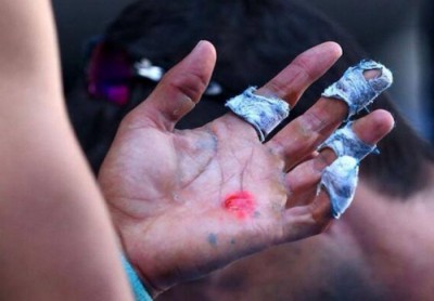 Rafa sa krvavim dlanom pobedio Dimitrova (FOTO)