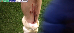 IGRAČ TOTENHEMA KRVAV HTEO DA SE VRATI U IGRU: Pogledajte reakciju Žoze Murinja! (VIDEO)