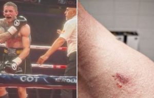 SKANDAL EPSKIH RAZMERA: Albanac ujeo srpskog boksera, umesto diskvalifikacije – dobio pobedu!